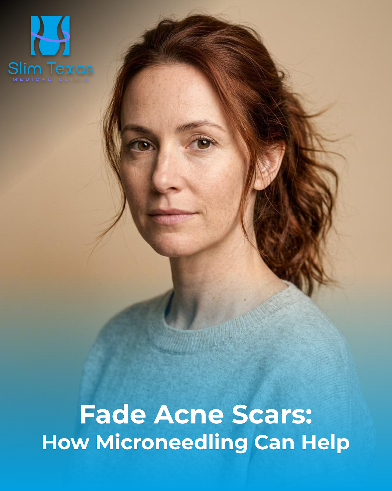 Fade Acne Scars: How Microneedling Can Help